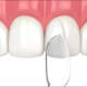 Dental Bonding
