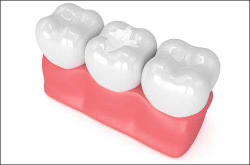 Dental Sealants