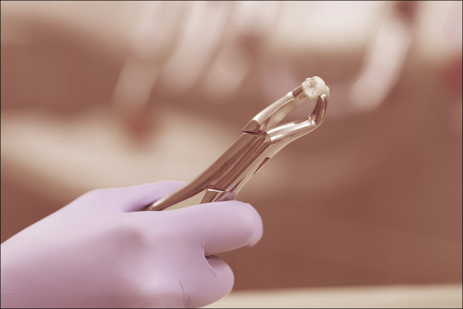 Wisdom Teeth Extraction