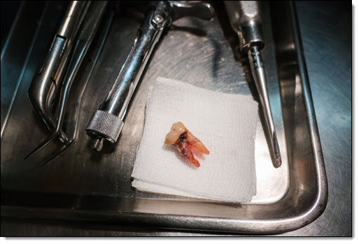Wisdom Teeth Extraction