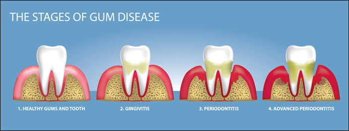 Gingivitis